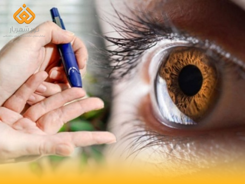 دیابت و عوارض چشمی